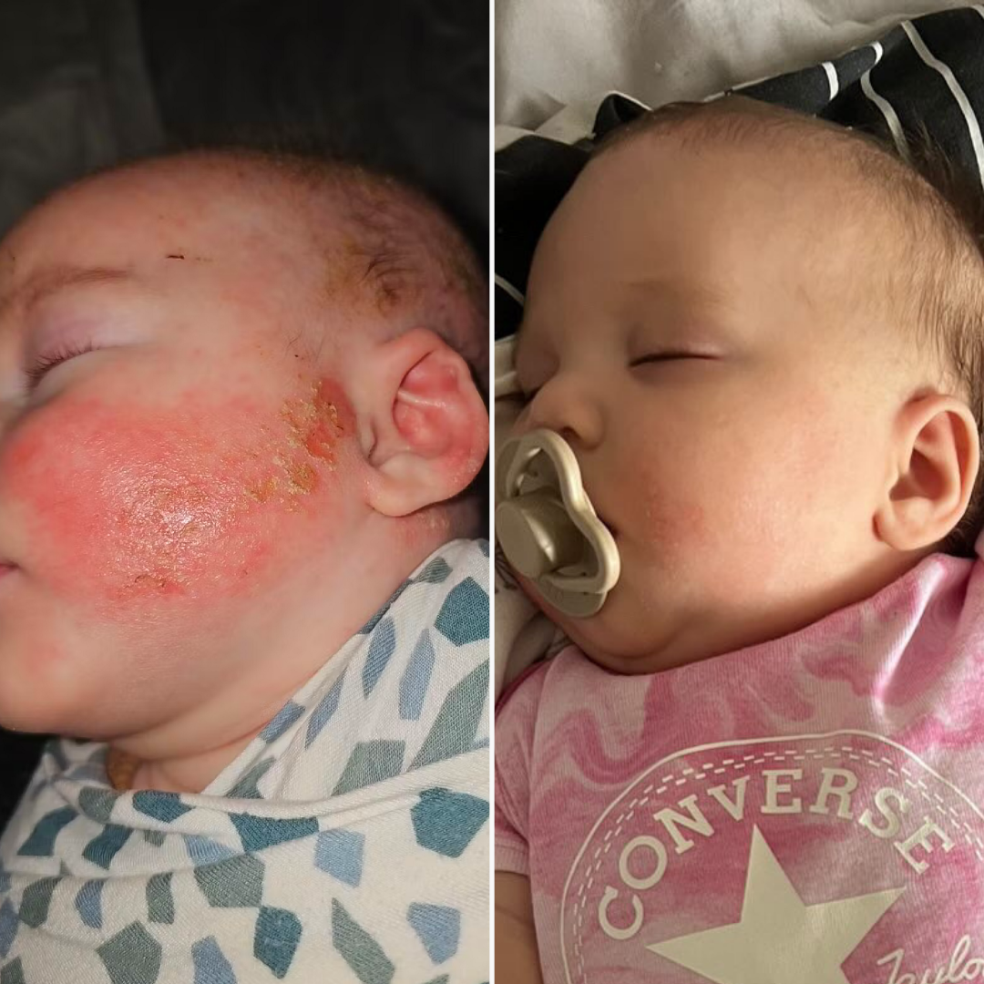 Eczemalieve® Eczema & Psoriasis Relief Lotion with “Liquid Gold” Oil