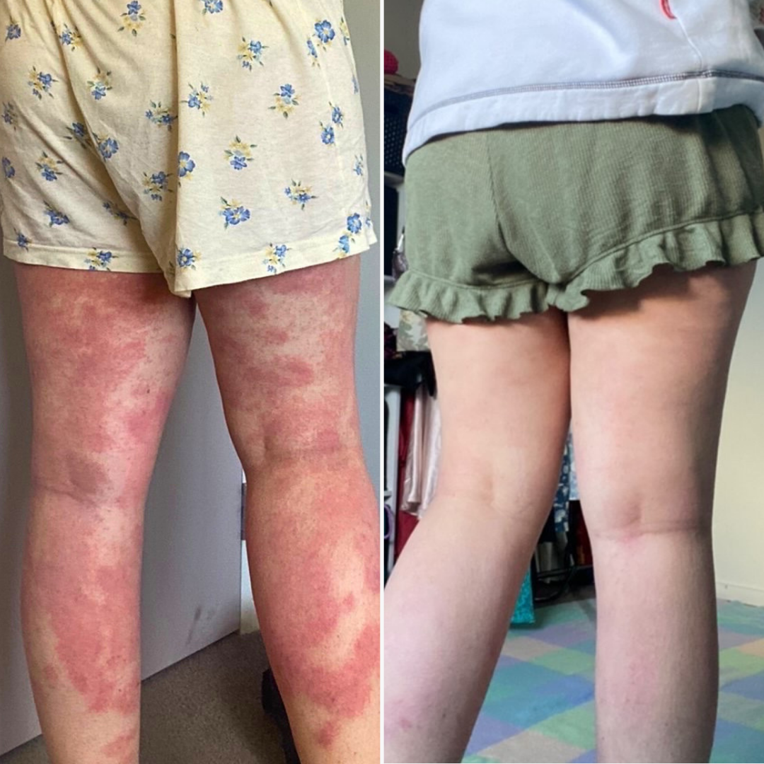Eczemalieve® Eczema & Psoriasis Relief Lotion with “Liquid Gold” Oil