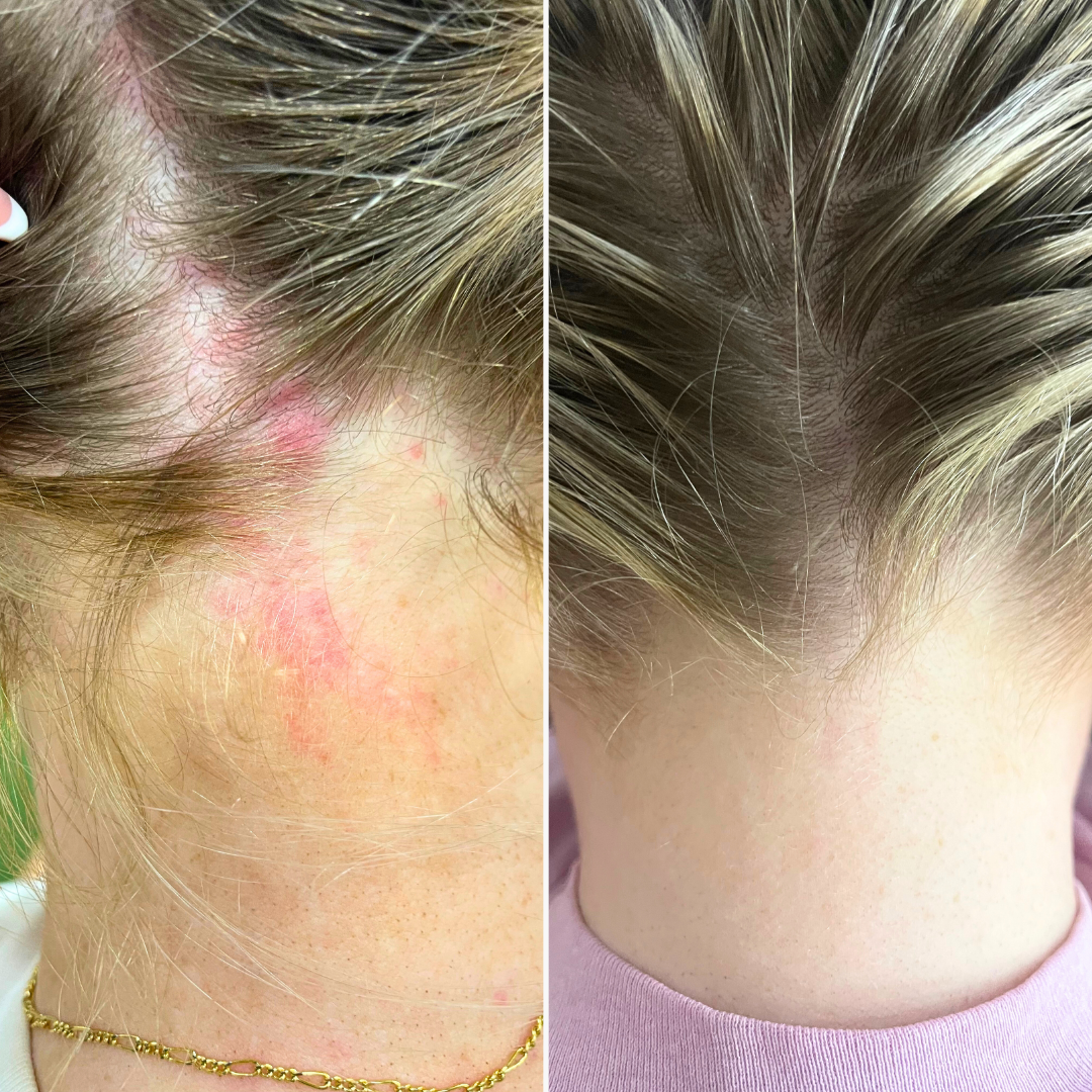 Eczemalieve® Eczema & Psoriasis Relief Lotion with “Liquid Gold” Oil