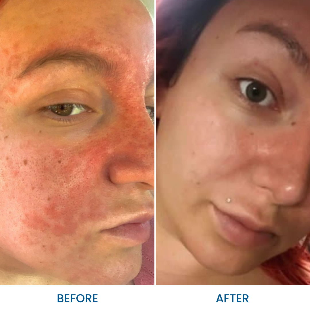 Eczemalieve® Eczema & Psoriasis Relief Lotion with “Liquid Gold” Oil