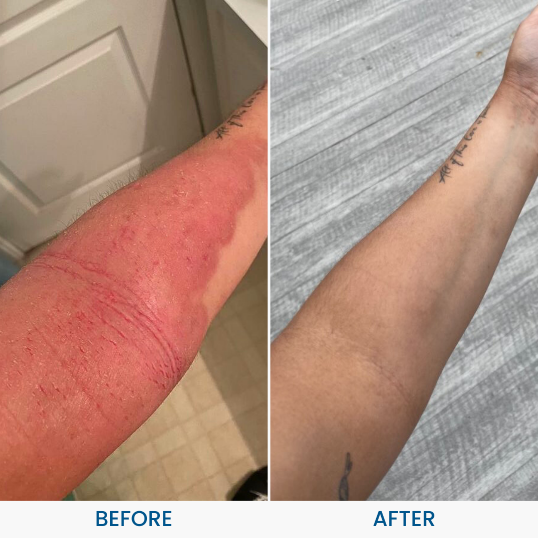 Eczemalieve® Eczema & Psoriasis Relief Lotion with “Liquid Gold” Oil