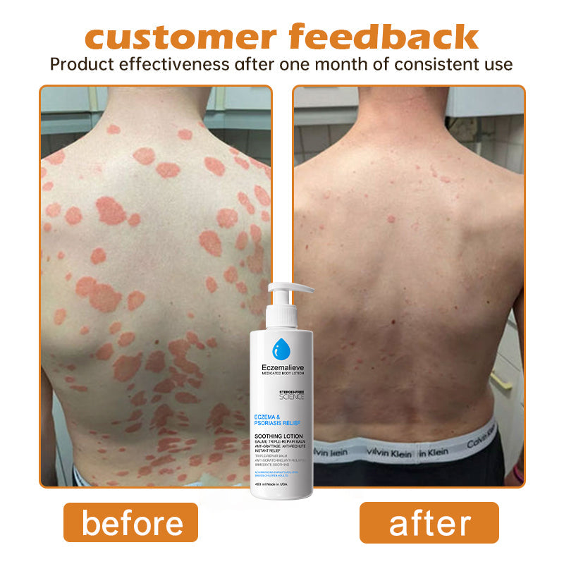 Eczemalieve® Eczema & Psoriasis Relief Lotion with “Liquid Gold” Oil