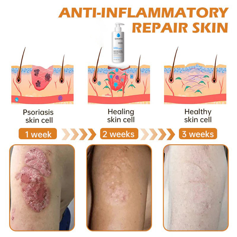 Eczemalieve® Eczema & Psoriasis Relief Lotion with “Liquid Gold” Oil