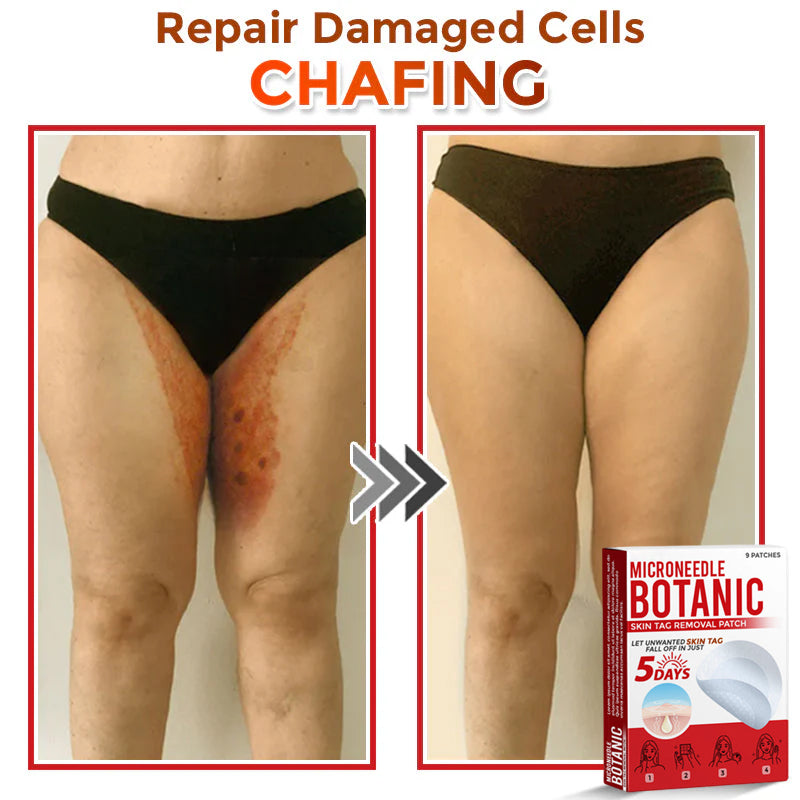 🌈MicroNeedle Botanic Skin Tag Removal Patch 🇺🇸 Made in the USA