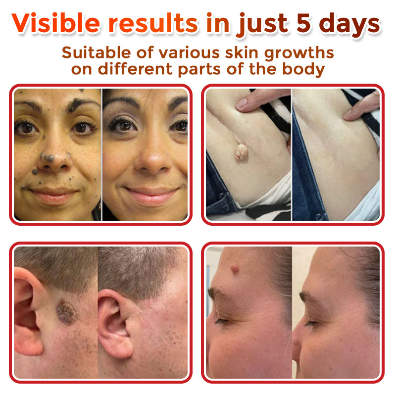 🌈MicroNeedle Botanic Skin Tag Removal Patch 🇺🇸 Made in the USA