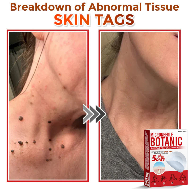 🌈MicroNeedle Botanic Skin Tag Removal Patch 🇺🇸 Made in the USA
