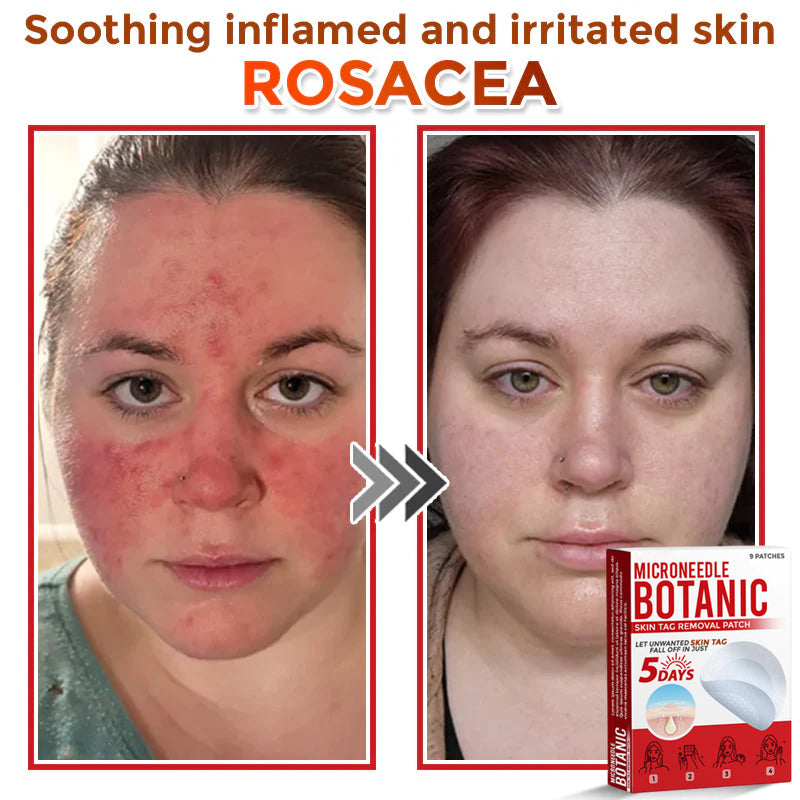 🌈MicroNeedle Botanic Skin Tag Removal Patch 🇺🇸 Made in the USA