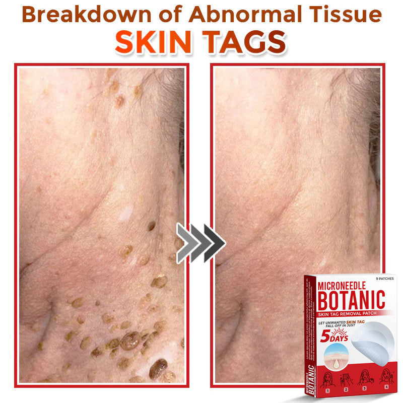 🌈MicroNeedle Botanic Skin Tag Removal Patch 🇺🇸 Made in the USA