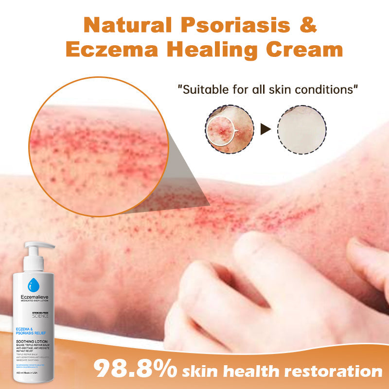 Eczemalieve® Eczema & Psoriasis Relief Lotion with “Liquid Gold” Oil