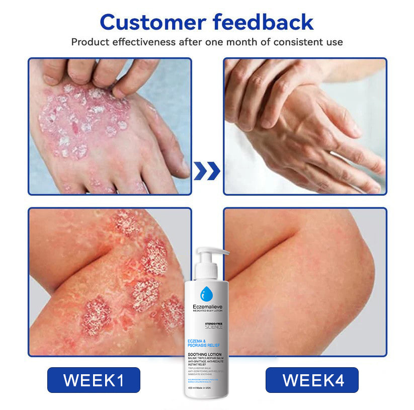 Eczemalieve® Eczema & Psoriasis Relief Lotion with “Liquid Gold” Oil