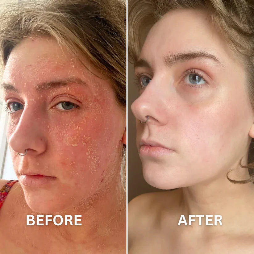 Eczemalieve® Eczema & Psoriasis Relief Lotion with “Liquid Gold” Oil