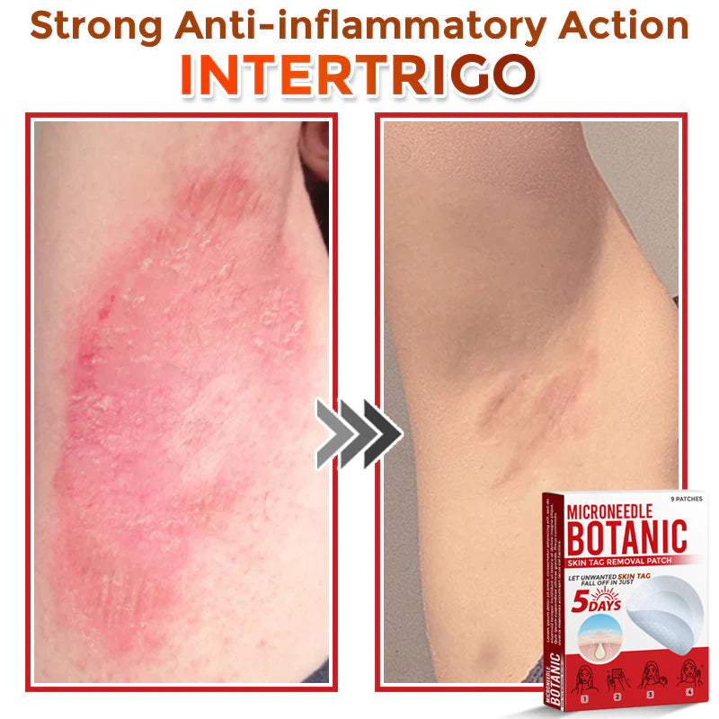 🌈MicroNeedle Botanic Skin Tag Removal Patch 🇺🇸 Made in the USA