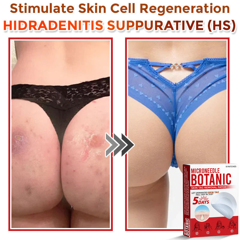 🌈MicroNeedle Botanic Skin Tag Removal Patch 🇺🇸 Made in the USA