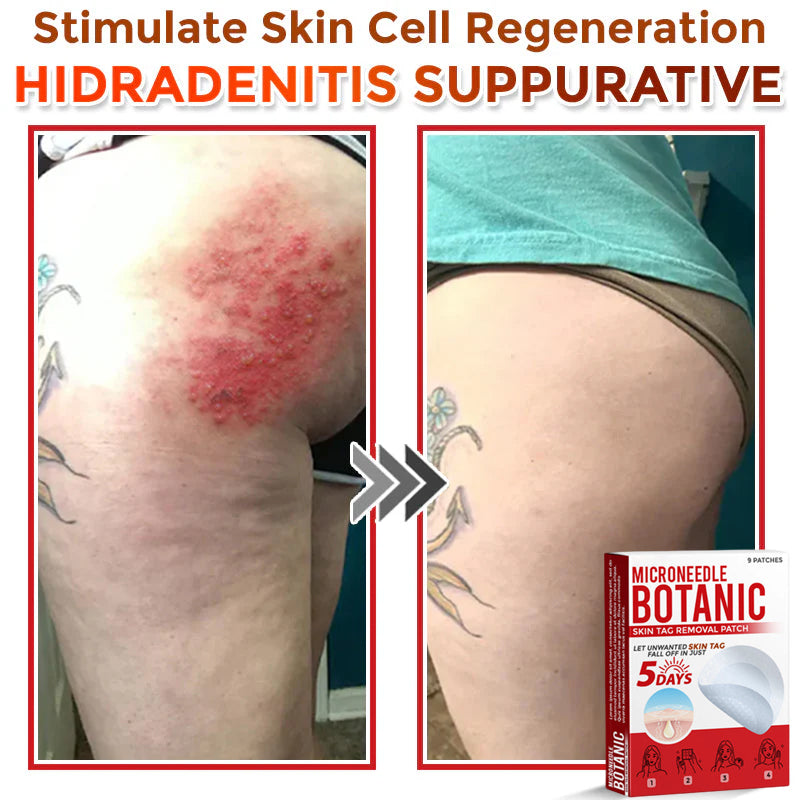 🌈MicroNeedle Botanic Skin Tag Removal Patch 🇺🇸 Made in the USA