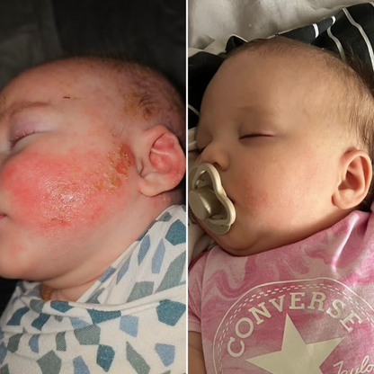 Eczemalieve® Eczema & Psoriasis Relief Lotion with “Liquid Gold” Oil