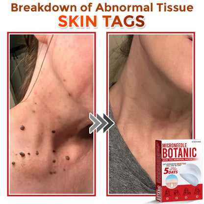 🌈MicroNeedle Botanic Skin Tag Removal Patch 🇺🇸 Made in the USA