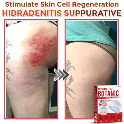 🌈MicroNeedle Botanic Skin Tag Removal Patch 🇺🇸 Made in the USA